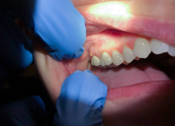 Best Broken or Cracked Tooth Emergency Dentist in Hughesville, MD